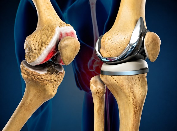 Best Joint Replacement Surgery in Goregaon