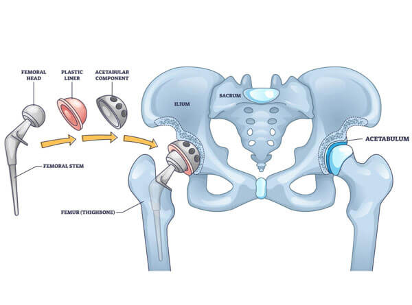 Hip Replacement Surgery Service