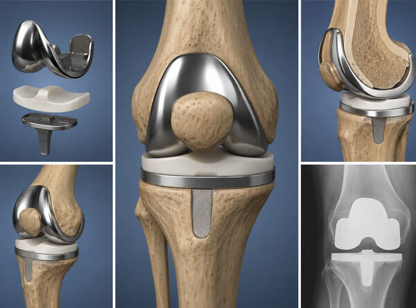 Knee Replacement Surgery Service