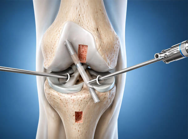 Knee Arthroscopy Treatment Service